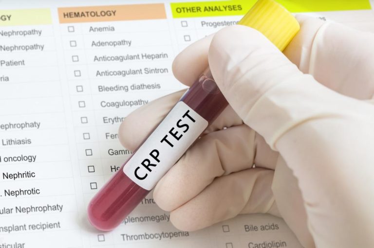 4 Easy tips to understand the CRP test result