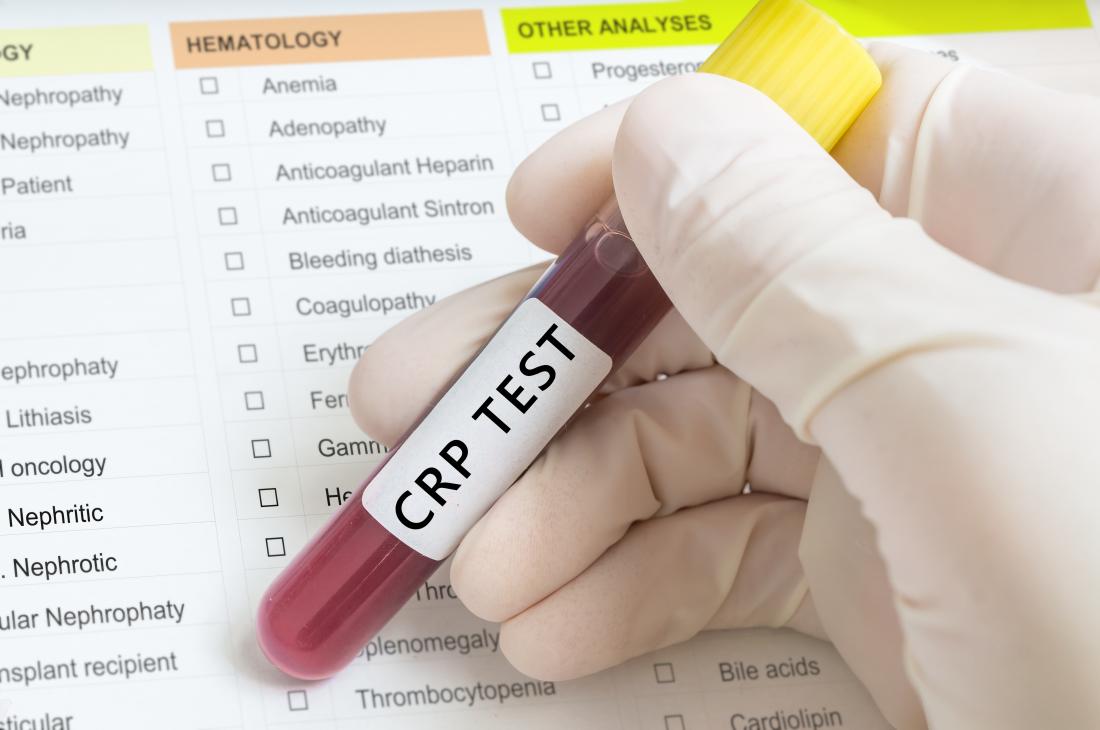 4 Easy tips to understand the CRP test result