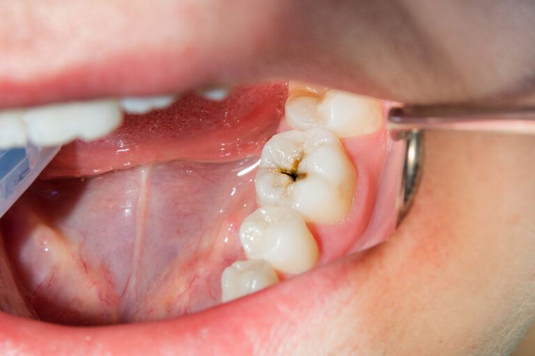 What Are Treatment Options and Preventive Measures for Cavities?